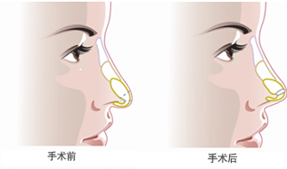 做完鼻子整容手术以后需要注意些什么吗？？