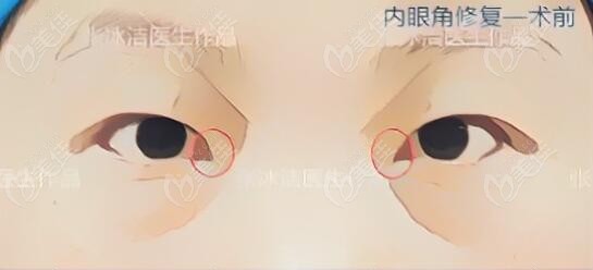 我找北京张冰洁做内眼角修复成功了,有内眼角开大了修复图片佐证