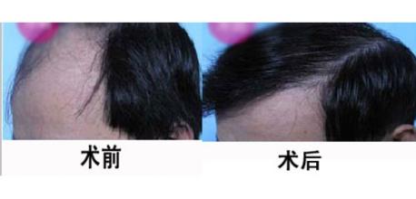 头发种植后多久可以碰水 术后应该如何护理