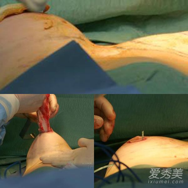 隆胸手术假体放入过程图片